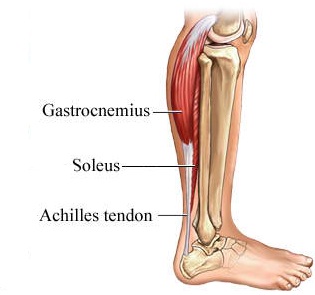 achilles tendonitis treatment