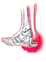 naples heel pain