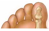 big toe pain