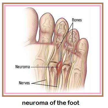 neuroma foot pain