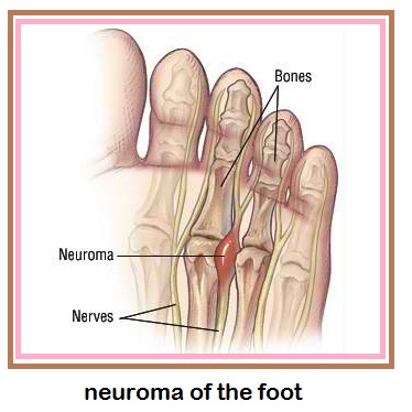 neuroma foot pain